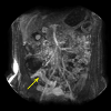 Thickened bowel wall